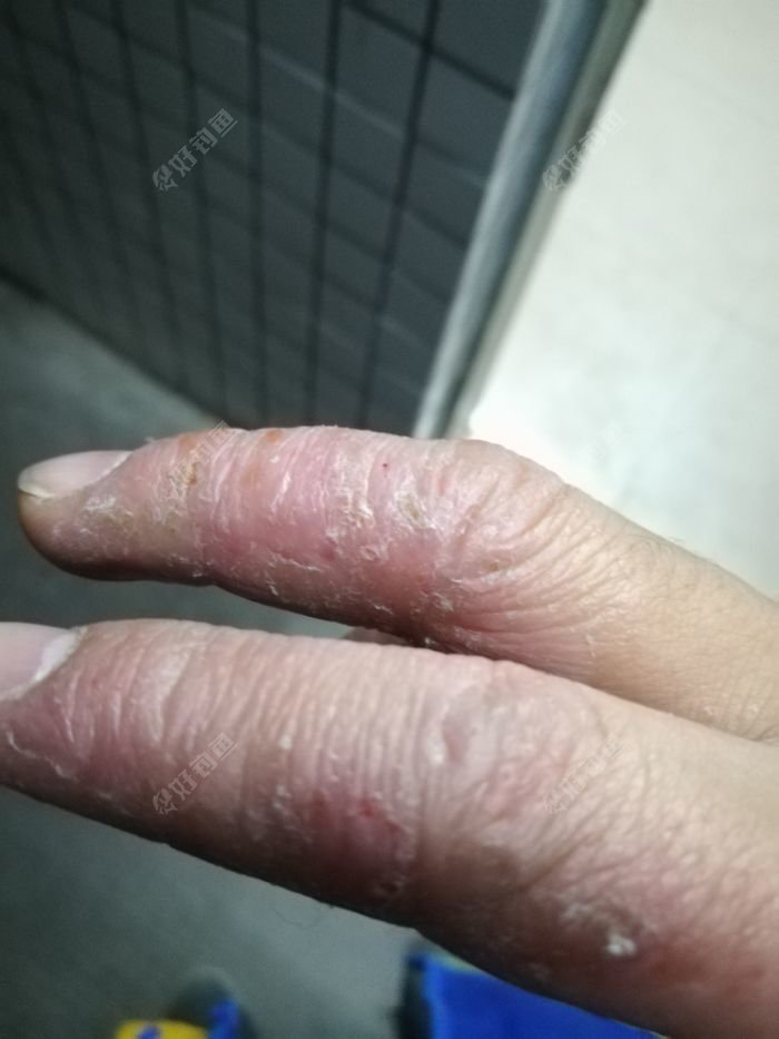 钓鱼手中毒如何根治